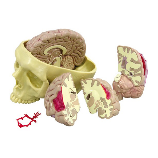 Brain Model - Half Normal & Half Pathology